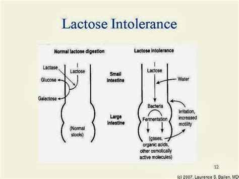 Lactose Intolerance Symptoms, Causes, Diagnosis, Treatment, Nutritions