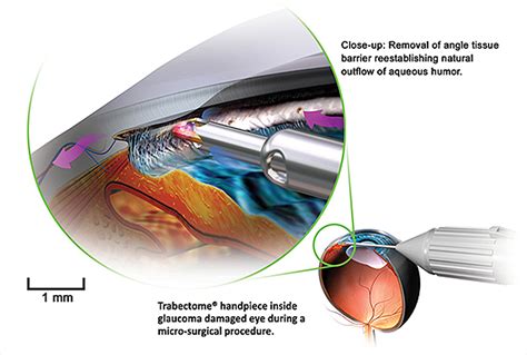 Migs Minimally Invasive Glaucoma Surgery
