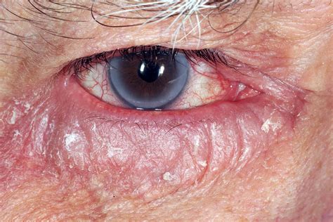 Allergic Eye Disease The Bmj