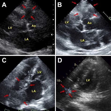 Pdf Primary Cardiac Lymphoma A Lesson Learned From An Unsuccessful