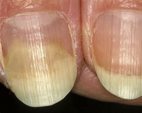 What Are Loose Nails And How To Treat Them Fix 4 Nails