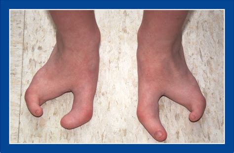Foot Malformations Musculoskeletal Key