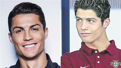 Cristiano Ronaldo Antes Y Después De La Cirugía Los Cambios De