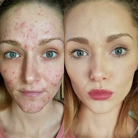 Cleansing, moisturizing, and sun protection. Before and after LimeLife | Natural skin care, Chemical ...
