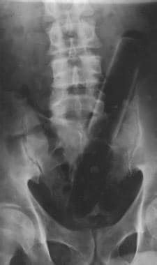 直肠异物在x光片上很容易看到