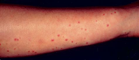 Figure 1 From Eruptive Pseudoangiomatosis Three Cases In Korean Middle