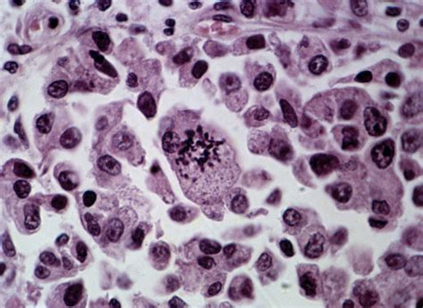Microscope Cancer Cells Pictures Micropedia