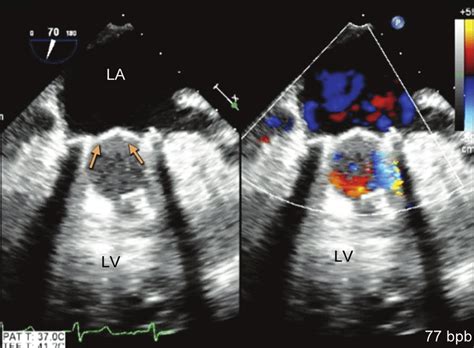 Tee Showing New Mechanical Mitral Valve Arrows With No Regurgitation