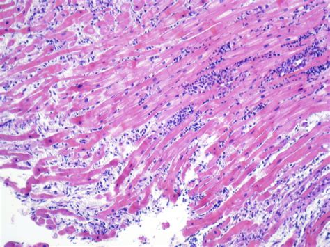 Of cardiology, maastricht university medical centre. Endomyocardial Biopsy: A Clinical Research Tool and a ...