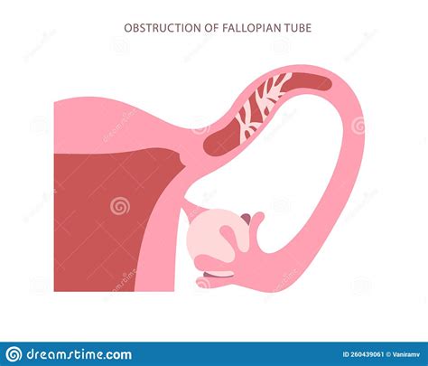 Flat Chart Of Fallopian Tube Obstructed Blockage Of Womb Tube High
