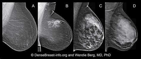 Dense Breasts Answers To Commonly Asked Questions National Cancer