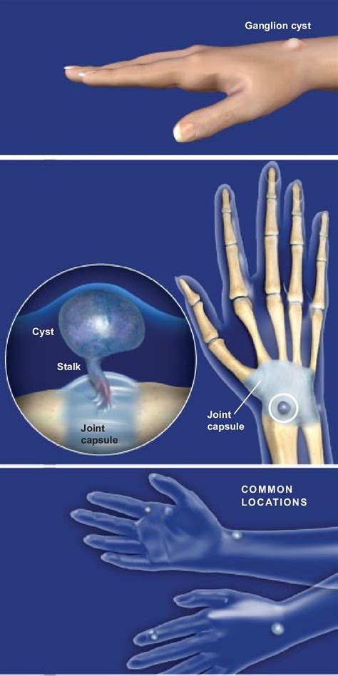 Ganglion Cysts Of The Hand Orthopaedic Associates Of Riverside