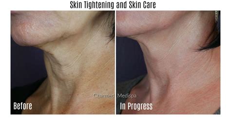 Skin Tightening Face And Neck Charmed Medispa