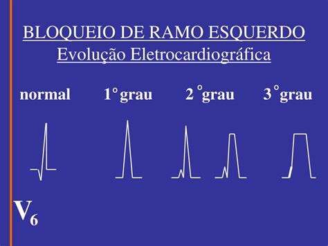 Bloqueio Do Ramo Esquerdo Pode Matar