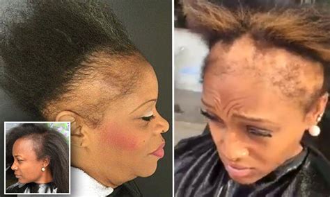 Hairstylist Warns About How Damaging Weaves Can Be Black Hair Growth Severe Hair Loss Hair Loss