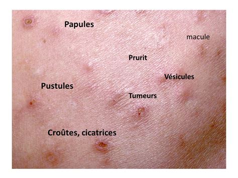 Papules Du Peau Résultats De Recherche Yahoo Résultats De La