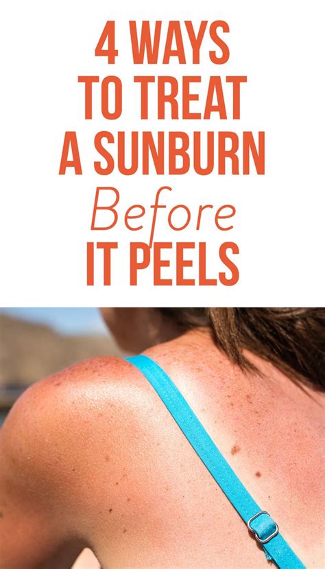 Ways To Treat A Sunburn Before It Peels So You Can Keep Your Tan Sunburn Peeling Sunburn
