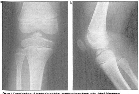 Figure 3 From Cartilaginous Avulsion Of The Tibial Eminence And