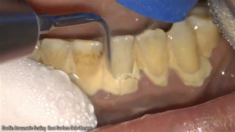 Plaque Removed Dental Calculus Long Overdue Plaque Removal Youtube