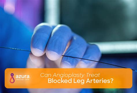 Angioplasty Procedure And Pad Treat Blocked Leg Arteries