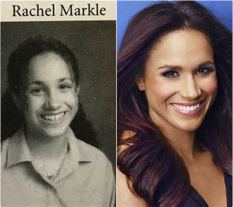 Meghan Markle Nose Job Rhinoplasty Before And After Photos