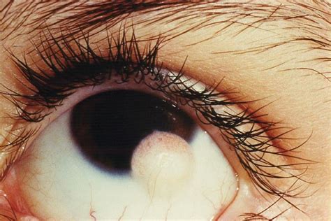 Misplaced Eyelash Or Ingrown Hair In The Eye Medizzy Journal