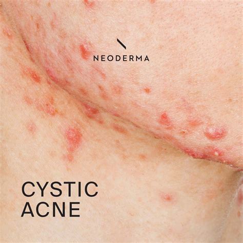Cystic Acne Neoderma