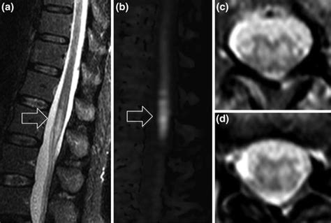Spinal Cord Infarction Neupsy Key