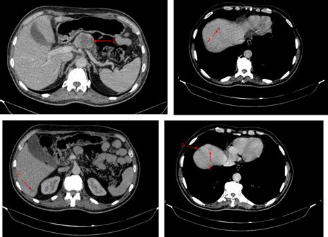 Ct Sections Showing Pancreatic Tumor 1 Upstream Pancreatic Atrophy
