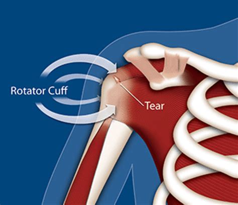 Rotator Cuff Tendinitis Exercises To Relieve Shoulder Pain Healdove
