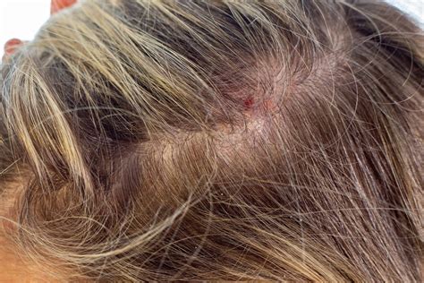 Prurigo Nodularis On Scalp — Identification And Treatment Myprurigoteam