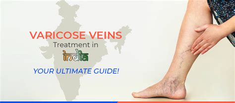Varicose Veins Treatment In India Your Ultimate Guide Karishma