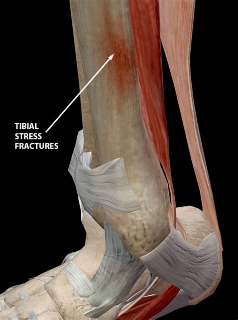 Hold On To Your Tibias The Anatomy And Causes Of Shin Splints