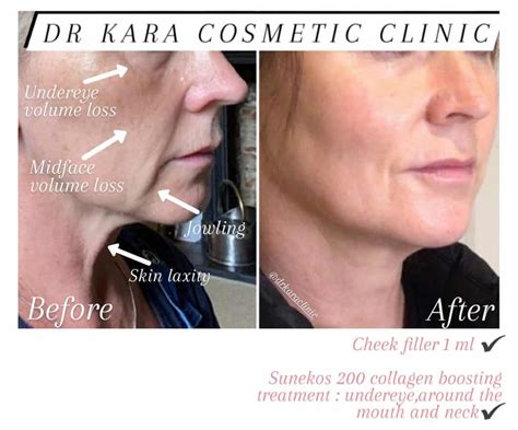 Sagging Skin Jowls Dr Kara Cosmetic Clinic