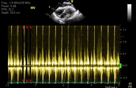 Cardiac Tamponade In Down S Syndrome Associated With Hypothyroidism An Uncommon Presentation