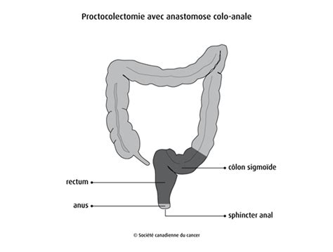 Résection De Lintestin Société Canadienne Du Cancer