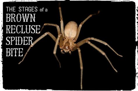 Brown Recluse Bite Pictures Stages Symptoms And Treatment Hubpages
