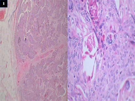 Inguinal Lymph Node Squamous Cell Carcinoma Of Unknown Primary Site A