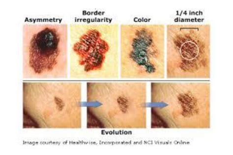 Moles Are Harmless But Sometimes Skin Cancer Can Develop In Or Around