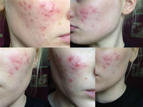 Red Acne Scarring On Cheeks Scar Treatments Community