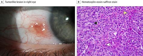 Angiolymphoid Hyperplasia With Eosinophilia Of The Conjunctiva