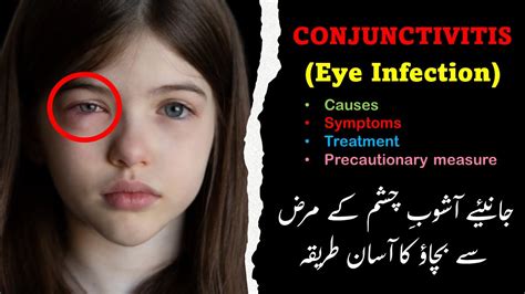 fastly spreading pink eye infection conjunctivitis in pakistan آشوب چشم youtube