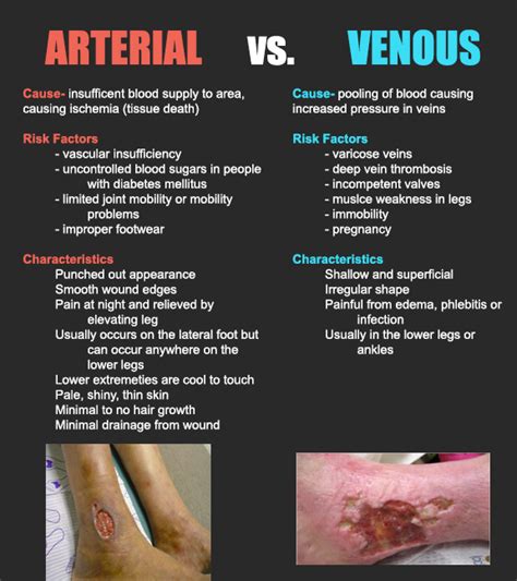 Venous Stasis Ulcer Vs Arterial Ulcer