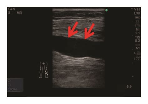 Ultrasound Screening Of Dilated Soleal Vein Sv A Shows Hypoechoic