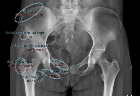Apophyseal Avulsion Fractures Are Usually The Result Of A Sudden