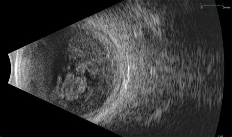 Ultrasound B Scan With A Hyperechoic Exudate Filling Almost The Entire