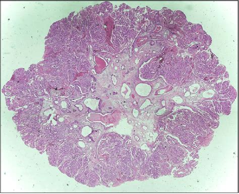 Microscopic Feature Of The Adenomatous Polyp The Polyp Composed Of