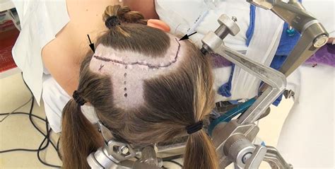 Scalp Incisions The Neurosurgical Atlas