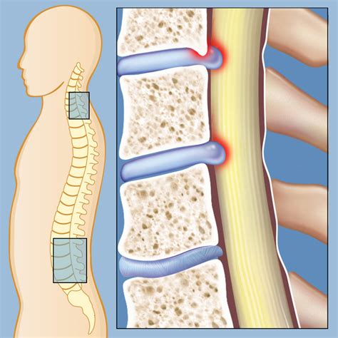 Spinal Stenosis And Nerve Pain Relief What Is The Best Pain Medicine