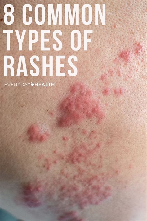 Skin Rash Adults Types